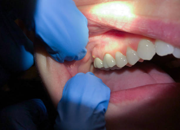 Best Emergency Dentist for Lost Fillings or Crowns in Henry, IL